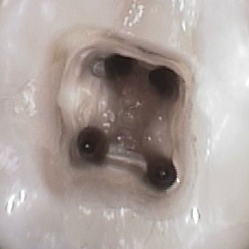 歯科拡大鏡